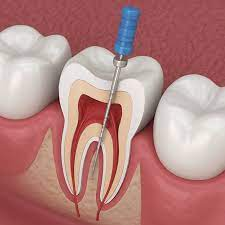 Best Root Canal Treatments 2025